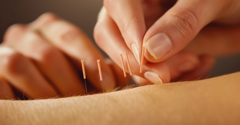 Discovering the Ancient Healing Power of TCM Acupuncture: A Holistic Wellness Journey in Singapore